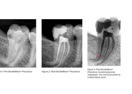 Bauman Endodontics Richard Bauman DMD