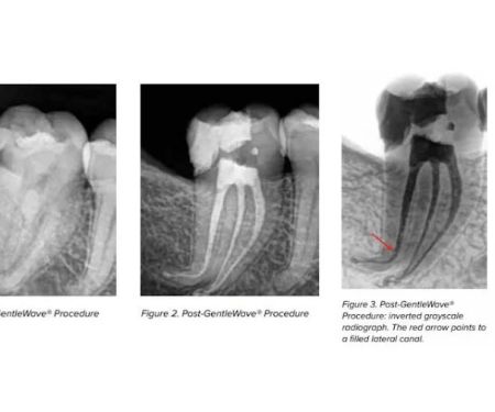 Bauman Endodontics Richard Bauman DMD