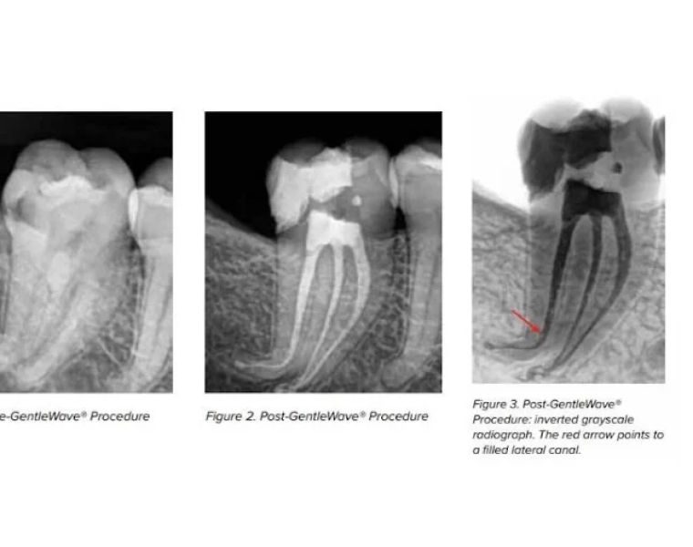 Bauman Endodontics Richard Bauman DMD