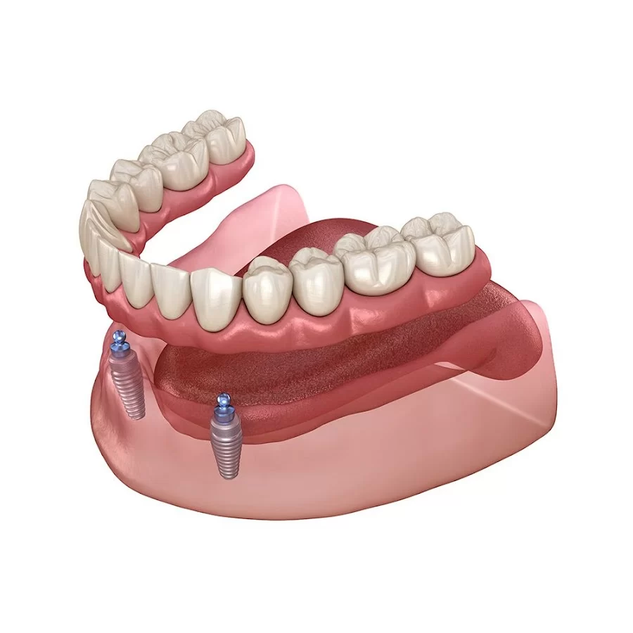 All Smiles Family Dentistry - Dentures, Extractions, Dental Implants, Quick Dentures 8