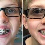 Las Vegas Braces
