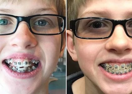 Las Vegas Braces
