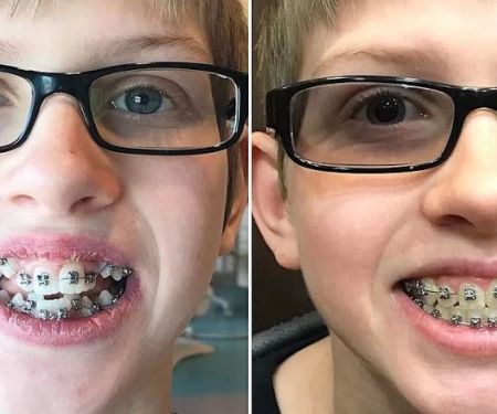 Las Vegas Braces
