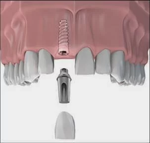 Dr Ed DeAndrade : Anthem Periodontics and Dental Implants 3