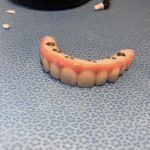 Affordable Dentures & Implants