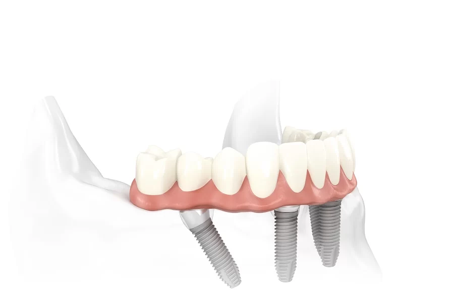 Robert G. Hale DDS Implant Center 2