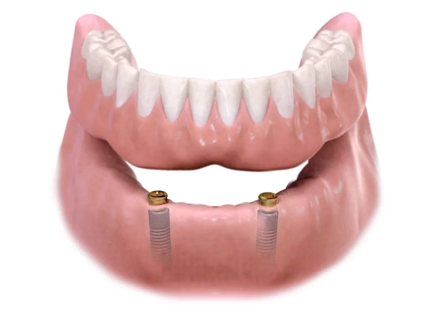 City Dental- Dental Implants and Orthodontics 1