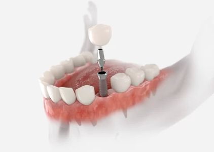 Denture Care Services