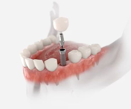 Denture Care Services