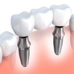 Bismarck Advanced Dental and Implants