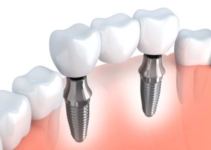 Bismarck Advanced Dental and Implants