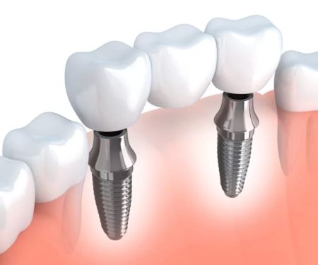Bismarck Advanced Dental and Implants