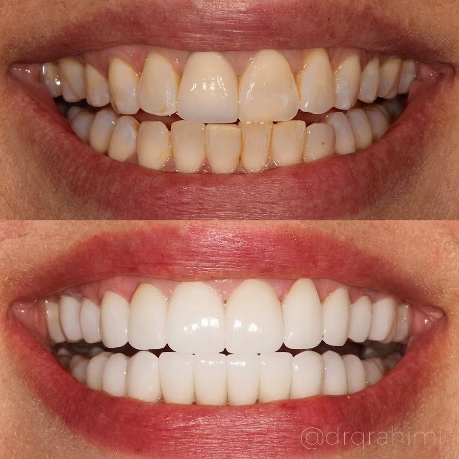 Calabasas Veneers by Dr.Kiumars Rahimi, DDS Dentistry in Calabasas 4