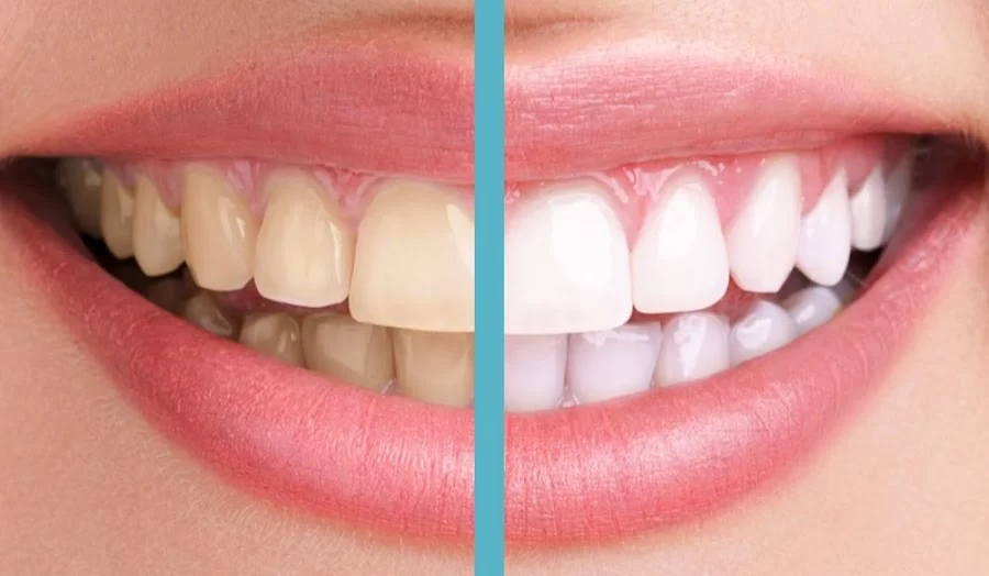 Pasadena Dentist Smile Now Dental 5