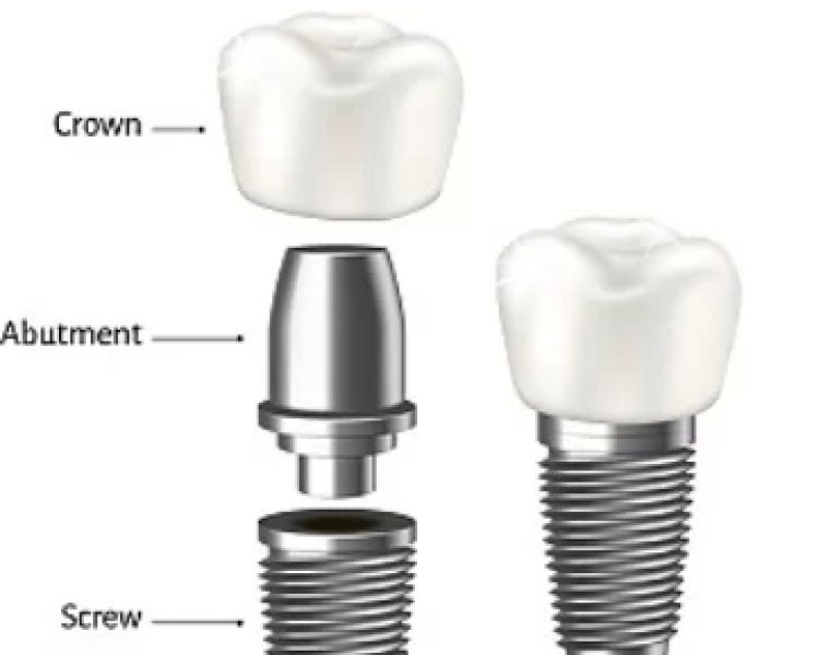 명치과 IMPLANT Dental office