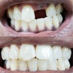 Whittier Dental Center & Orthodontics - Best Dental Implants