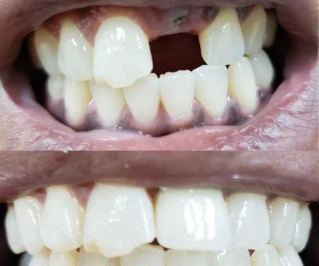Whittier Dental Center & Orthodontics - Best Dental Implants