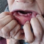 Affordable Dentures & Implants