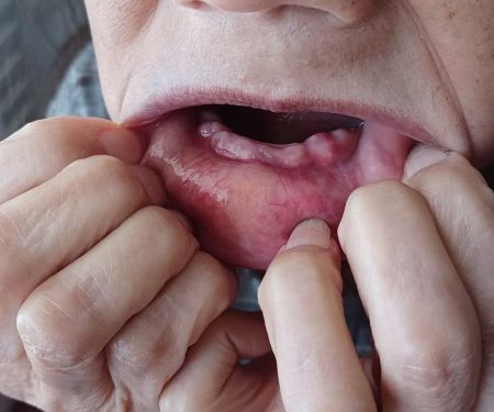 Affordable Dentures & Implants