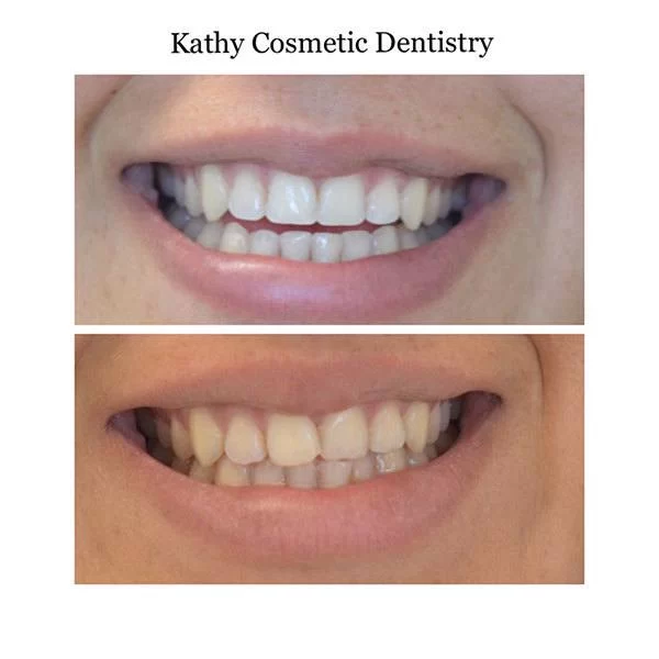 Kathy Cosmetic Dentistry 1