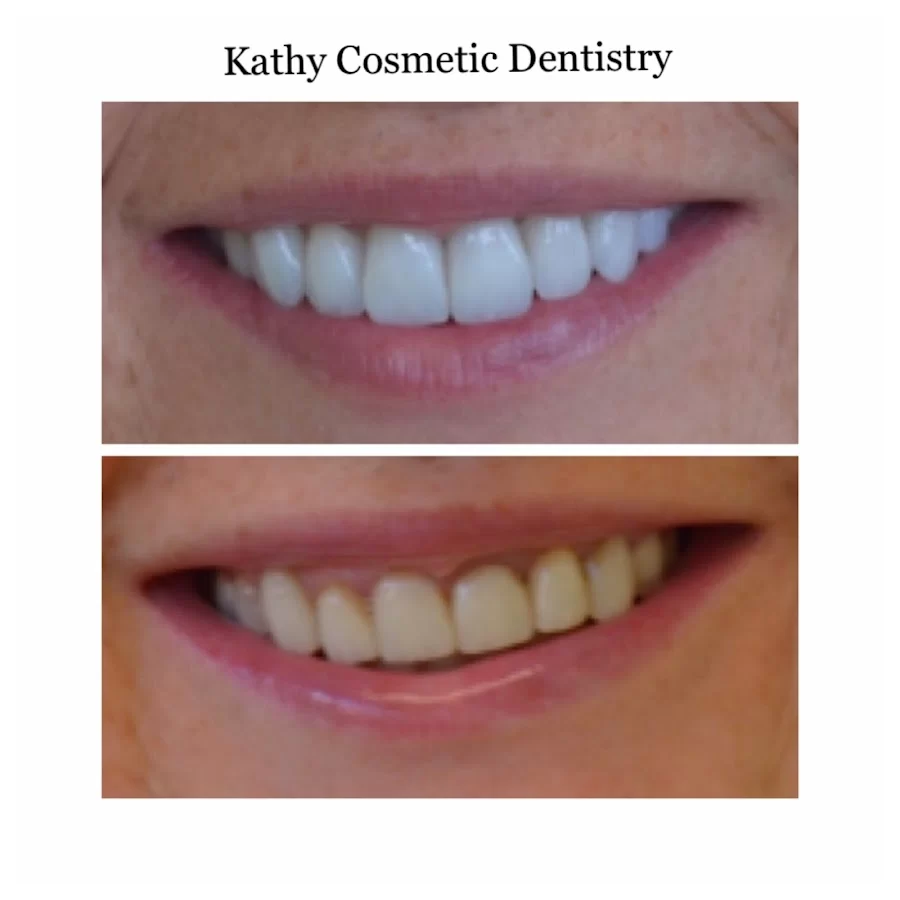 Kathy Cosmetic Dentistry 3