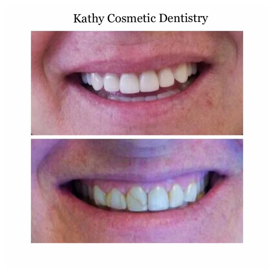 Kathy Cosmetic Dentistry 8