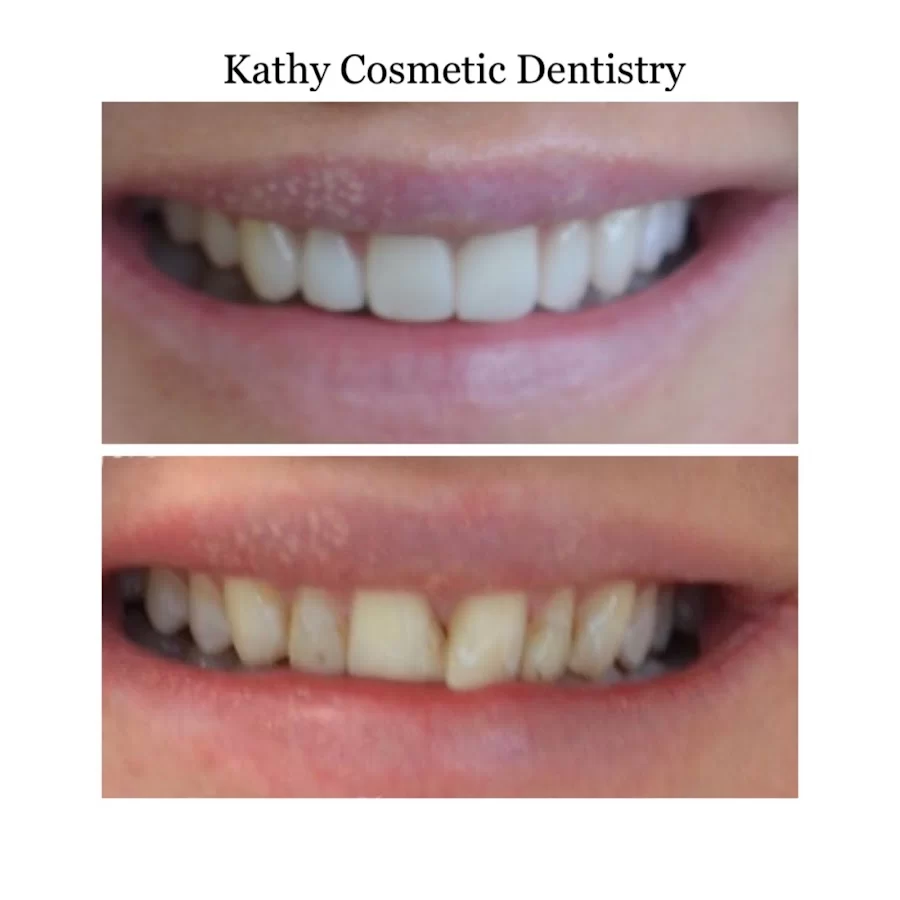 Kathy Cosmetic Dentistry 4