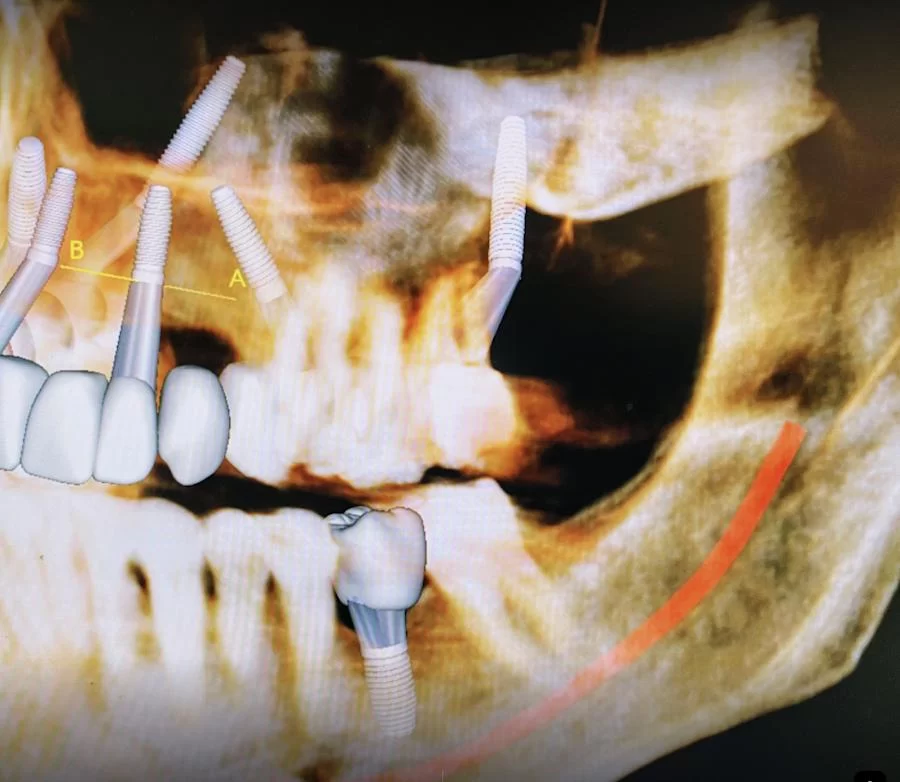 Burbank Dental Implants: Ramsey A. Amin D.D.S. 8