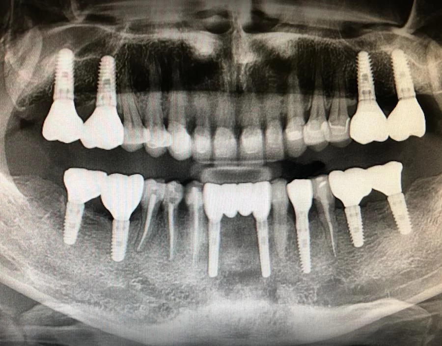 Burbank Dental Implants: Ramsey A. Amin D.D.S. 9