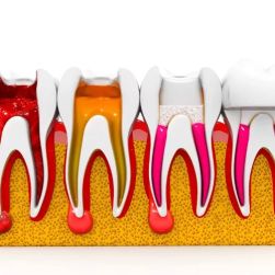 Best Dentist for Root Canal Procedures in Chicago: Find Expert Care and Relief