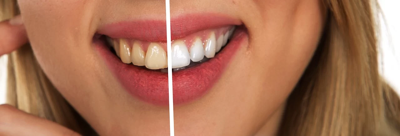 Teeth Whitening for Smokers: How to Achieve a Brighter Smile