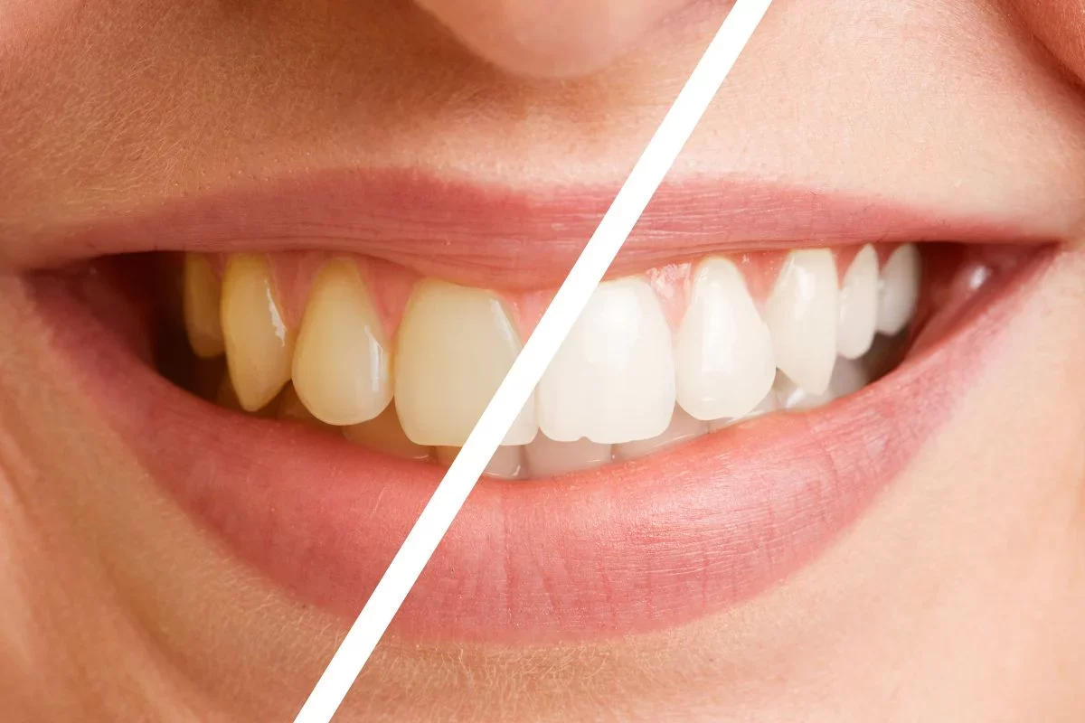 What is the Best Cosmetic Treatment for Teeth Whitening? Comprehensive Guide