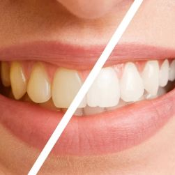 What is the Best Cosmetic Treatment for Teeth Whitening? Comprehensive Guide