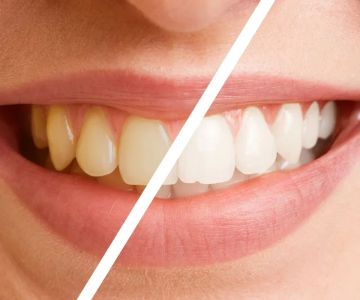 What is the Best Cosmetic Treatment for Teeth Whitening? Comprehensive Guide