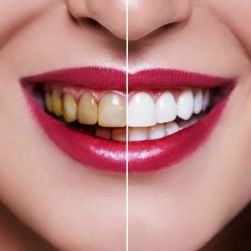 The Ultimate Guide to Teeth Whitening: Achieve a Bright, Healthy Smile