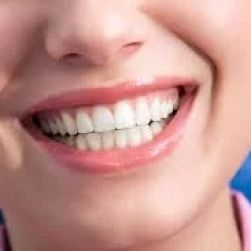 Transform Your Smile with Veneers: A Comprehensive Guide