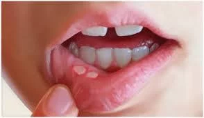 Understanding Oral Ulcers: Causes, Symptoms, and Effective Treatments