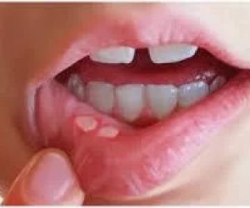 Understanding Oral Ulcers: Causes, Symptoms, and Effective Treatments