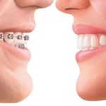 Happy Braces Orthodontics, La Mirada
