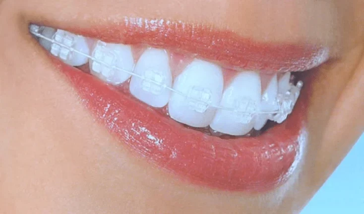 Comprehensive Orthodontic Options for Adults with Bite Problems