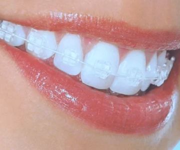 Comprehensive Orthodontic Options for Adults with Bite Problems