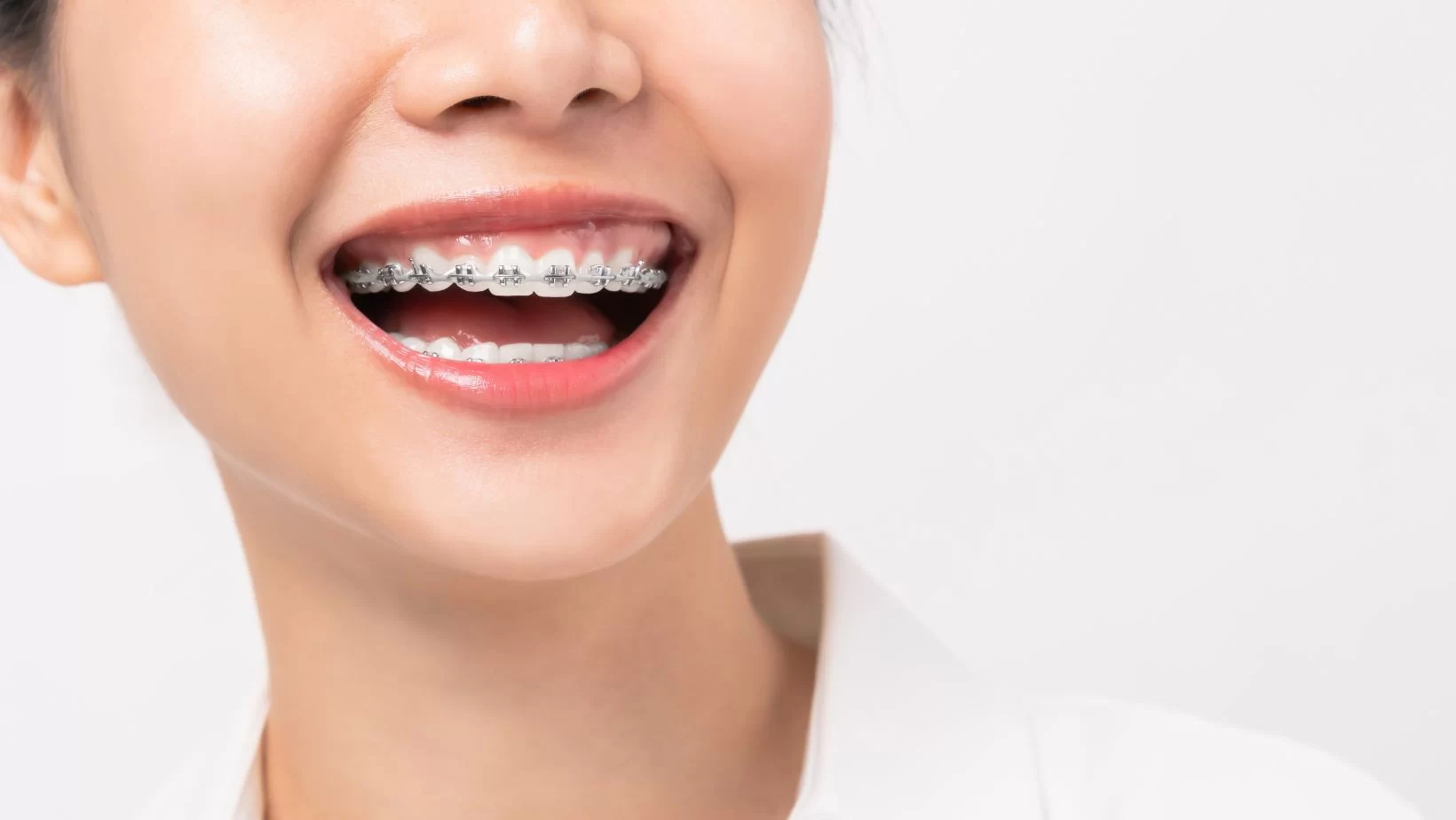 Comprehensive Guide to Orthodontic Treatment for Overbite and Underbite