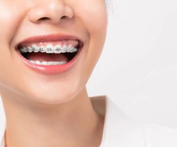 Comprehensive Guide to Orthodontic Treatment for Overbite and Underbite