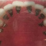 Rapid Braces