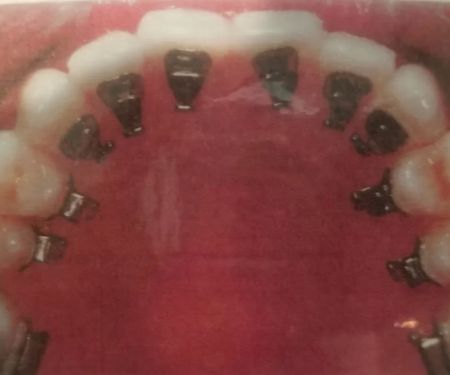Rapid Braces
