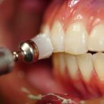 SiSo Dent