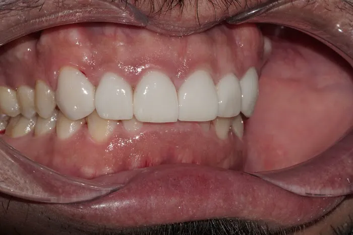 SiSo Dent Picture 2
