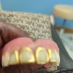 Affordable Dentures & Implants