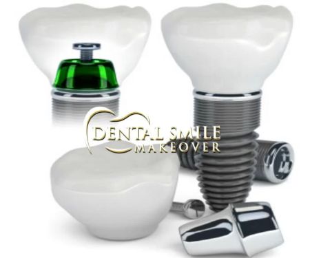 Dental Smile Makeover