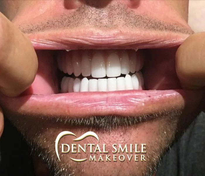 Dental Smile Makeover Picture 5